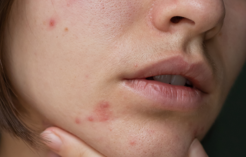 Гайд по акне